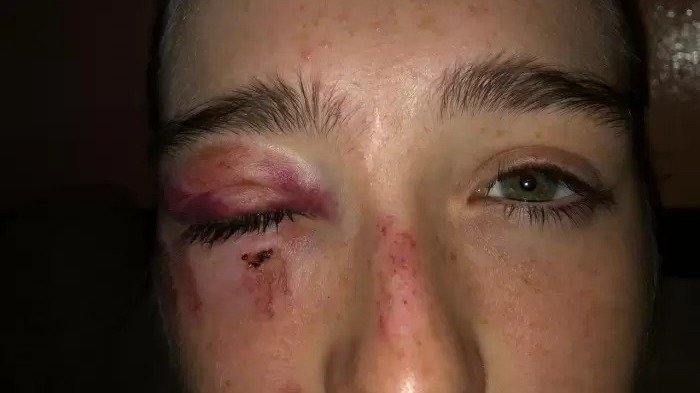 San Martín: un encapuchado golpeó violentamente a una adolescente cuando salía de la escuela